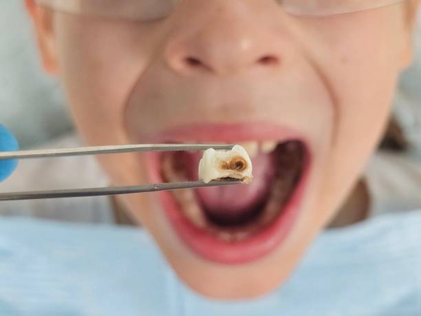 Best Emergency Root Canal Treatment in Goodman, MO